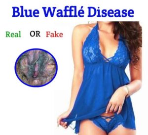 Blue Waffle Disease picture