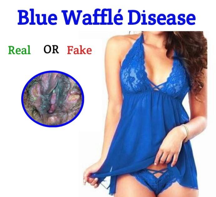 Blue Waffle Disease Webmd Separates Facts From Fiction Pictures Public Heal...