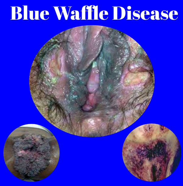Blue waffle disease