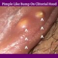 pimple like bump on clitorial hood