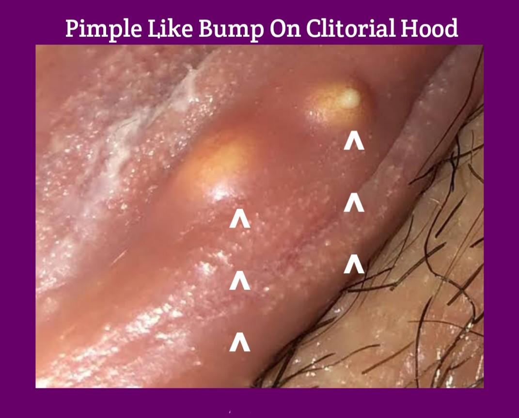Hard on majora labia bump single Vaginal Lumps
