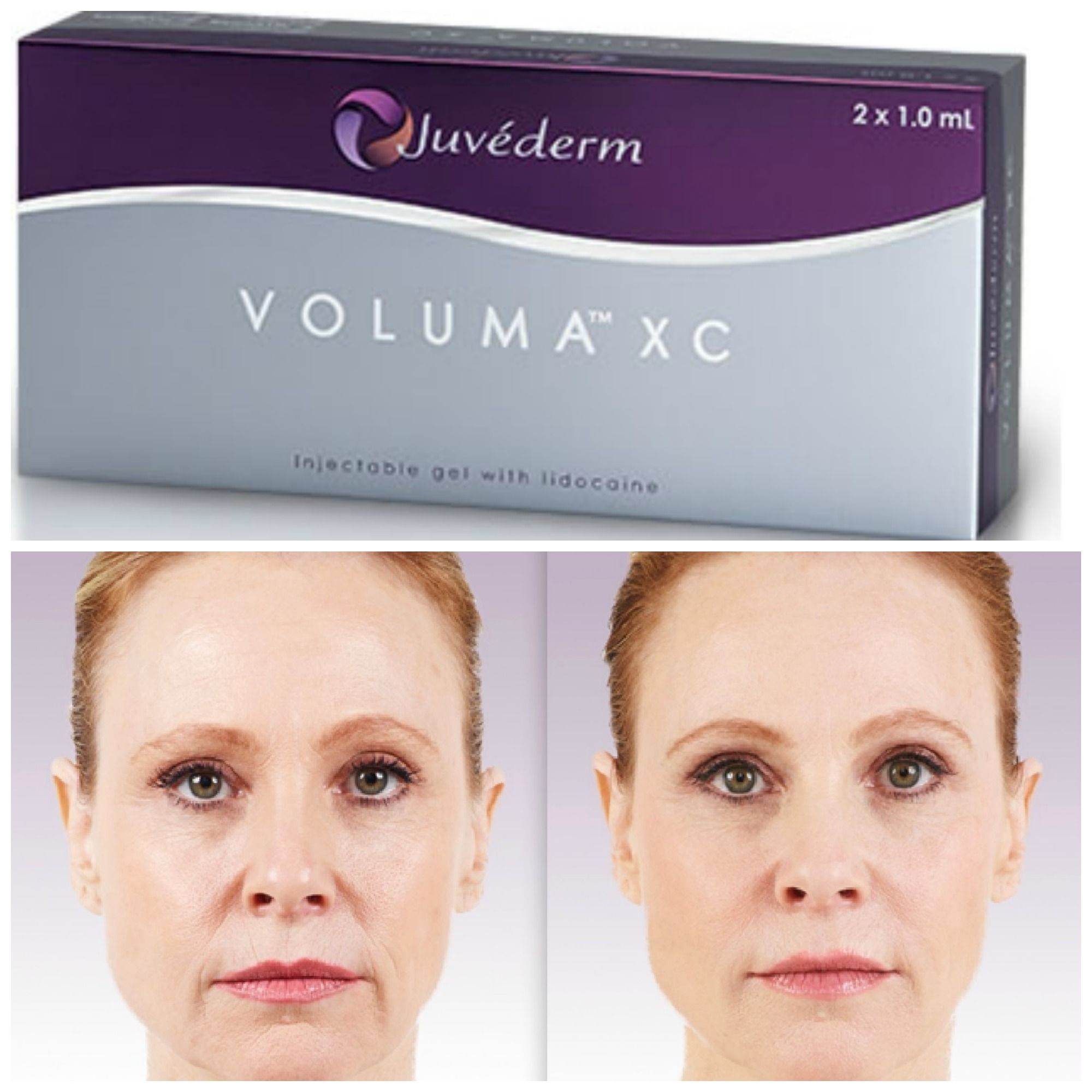 How Long Before Juvederm Takes Effect