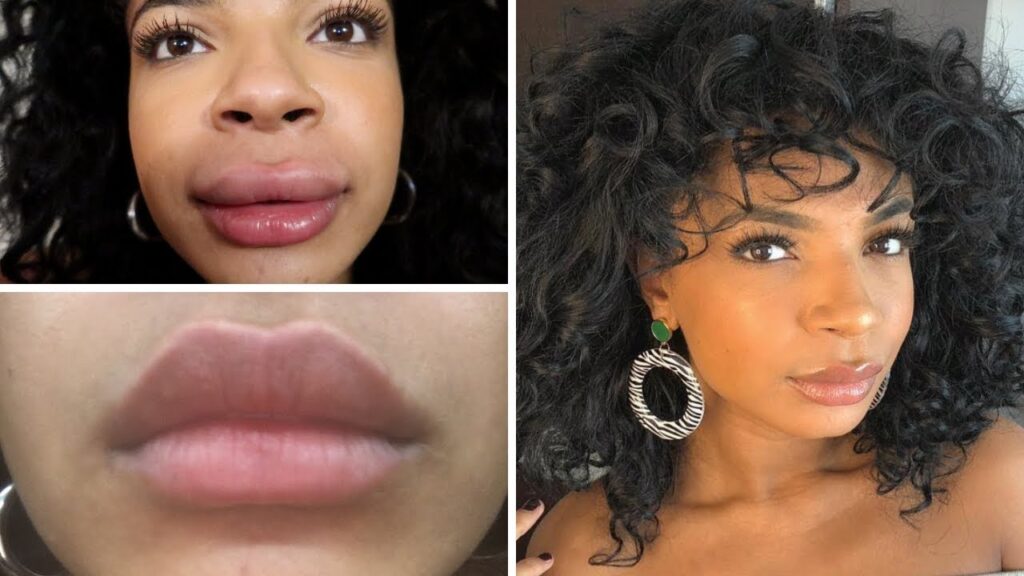 How Long Does Swelling Last After Juvederm? Public Health