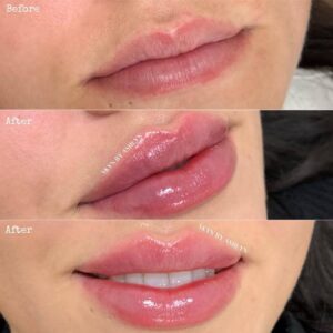 How Long Does Swelling Last After Lip Filler