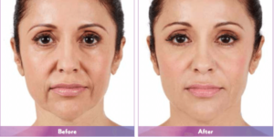 Juvederm before and after picture