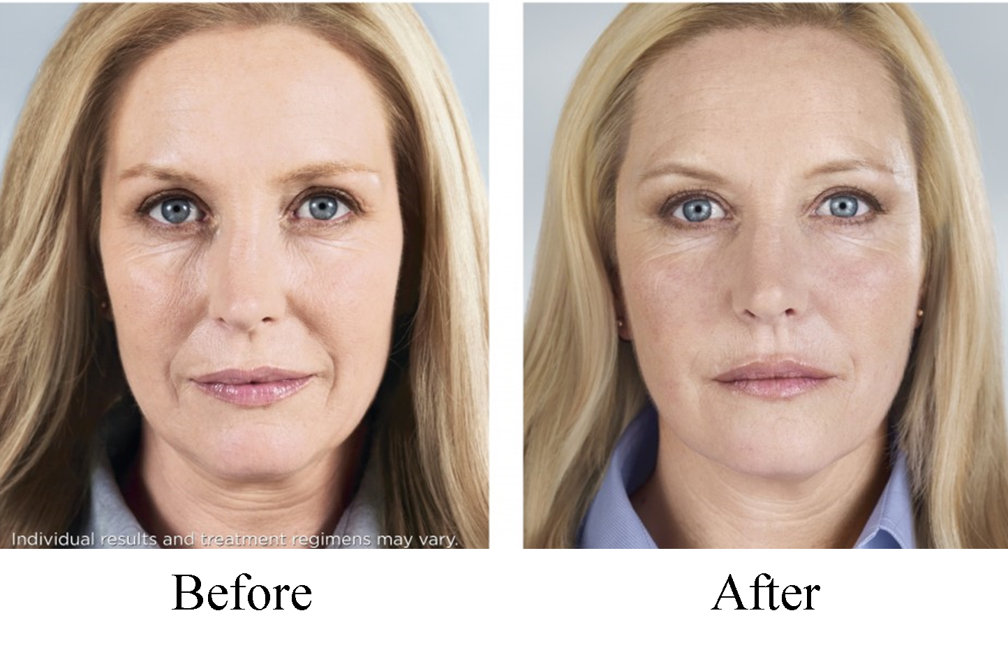 Sculptra before and after pictures