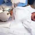 circumcision recovery photos