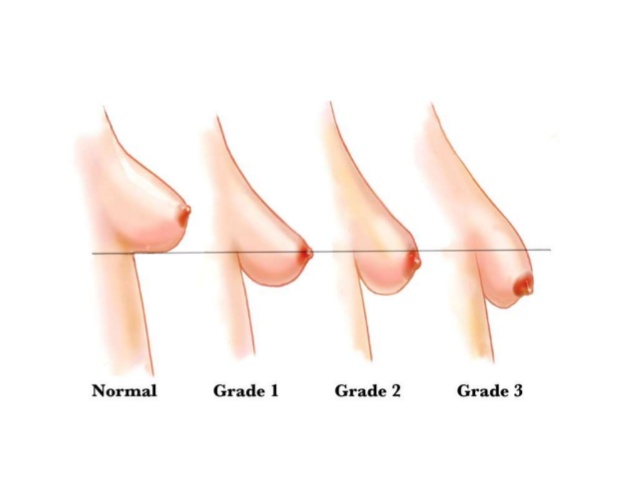 stages of breast sagging