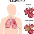Can Flagyl Treat Pneumonia