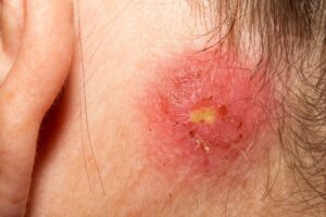 Can Flagyl Treat Staph Infection