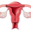 How To Clean Uterus After A Miscarriage Naturally