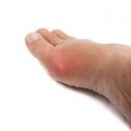 Pictures Of Gout Blisters On Feet