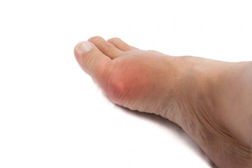 Pictures Of Gout Blisters On Feet