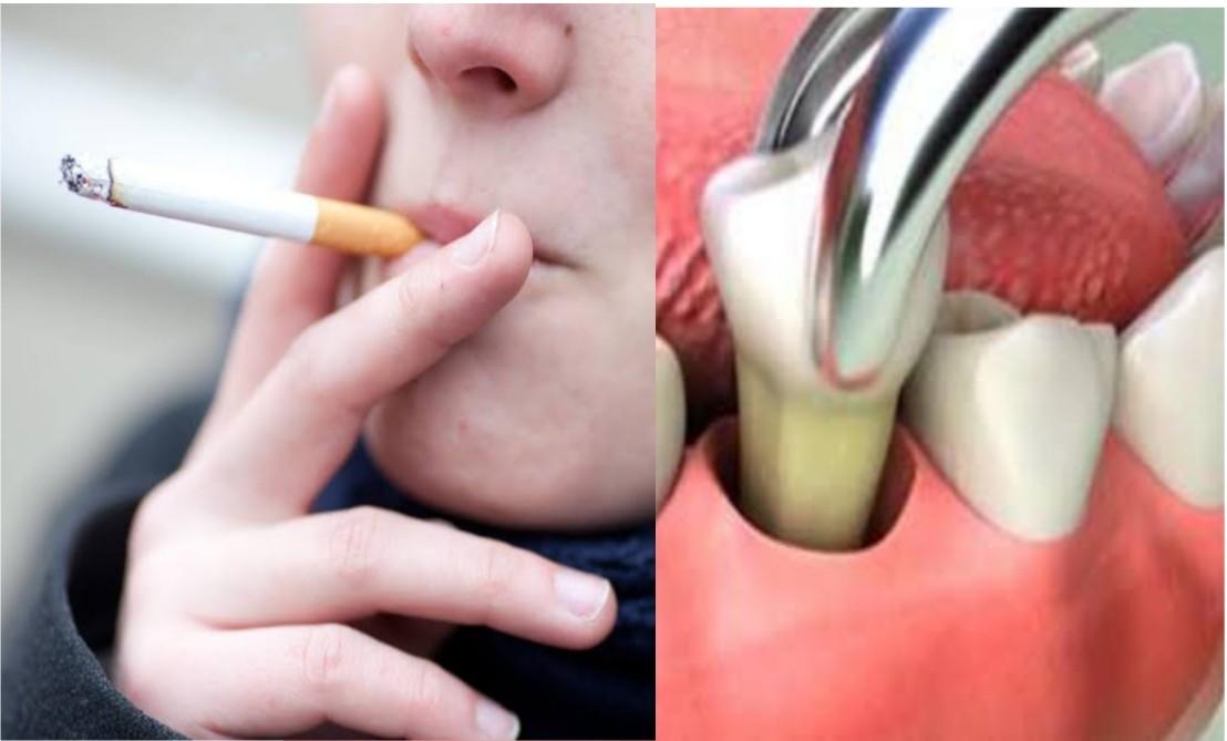 When Can I Smoke After Tooth Extraction | Public Health
