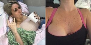 breast implants gone wrong pictures before and after