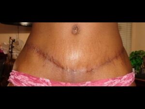 How Much Does A Tummy Tuck Cost In South Africa