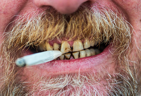 How does Smoking Affects Your Teeth 