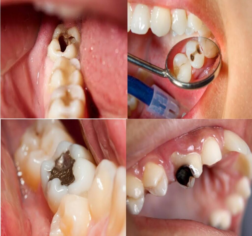 What Does A Tooth Cavity Look Like Public Health