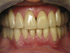 Why Are My Teeth Yellow When I Brush Them Everyday