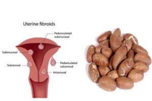bitter kola and fibroid