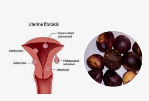 wonderful kola and fibroid