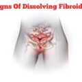 Signs of Fibroids Dissolving