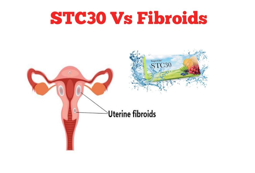 can stc30 cure fibroids