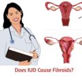 Can IUD Cause Fibroids