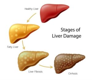 How Long To Abstain From Alcohol To Repair Liver