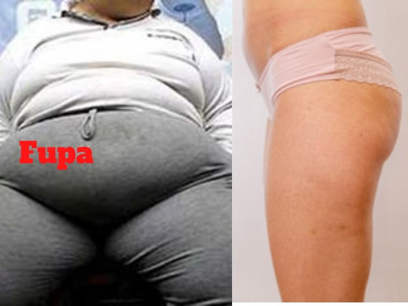 how to get rid of fupa