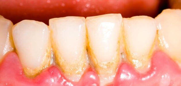 How To Get Rid Of Calcium Deposits On Teeth