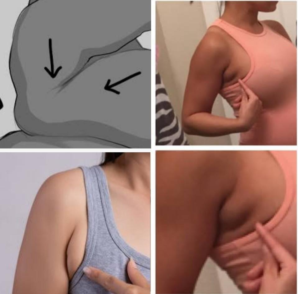 How To Get Rid Of Side Boob Fat