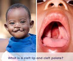 What Causes Cleft Lip