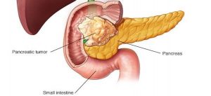 What Causes Pancreatic Cancer