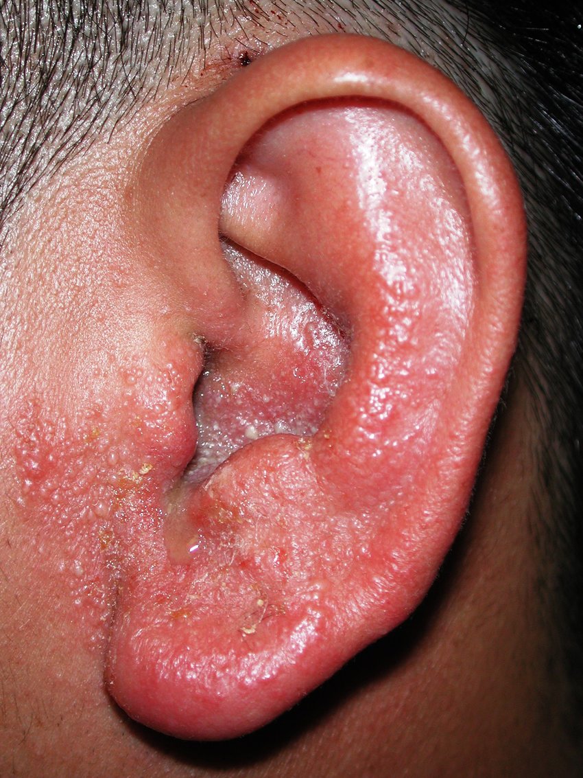 Can Allergies Cause Recurring Ear Infections