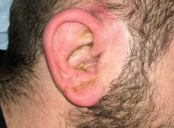Staph Infection in ear