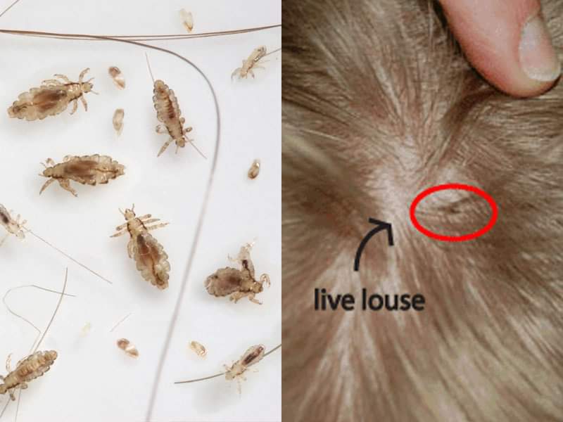 How To Check Yourself For Lice - Public Health
