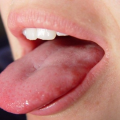 How To Get Rid Of Adderall Tongue