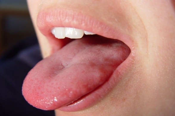 How To Get Rid Of Adderall Tongue