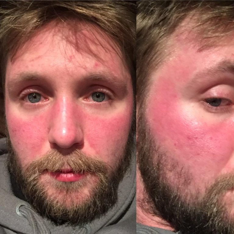 How Does Degloved Face Happen (Pictures) Public Health