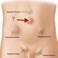 How To Identify A Hernia