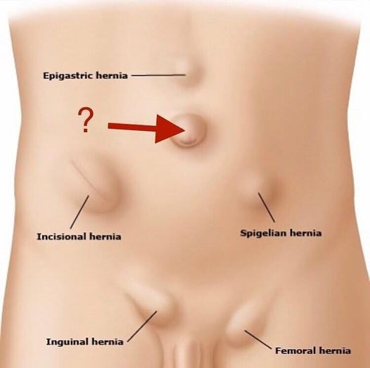 How To Identify A Hernia