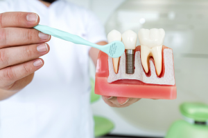 The Do’s and Don’ts of Dental Implant Aftercare