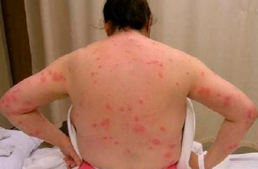 What Do Bed Bug Bites Look Like On Humans