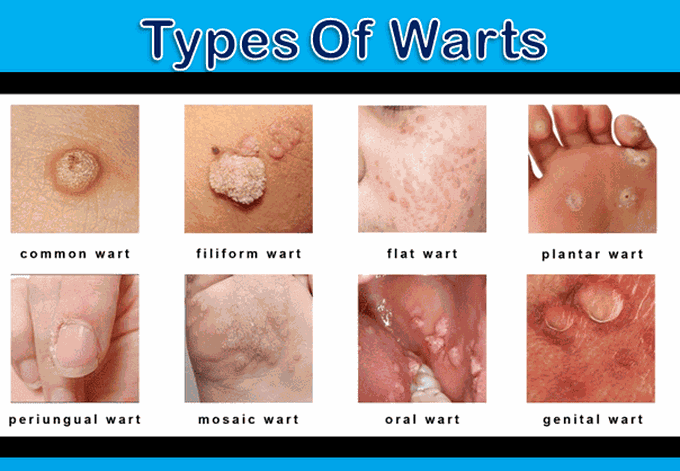 how to identify a wart