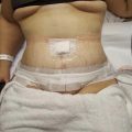 Symptoms of Torn Internal Stitches After Tummy tuck