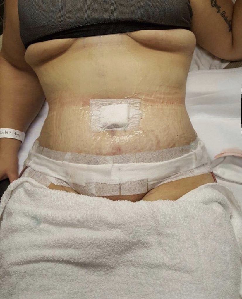 Symptoms of Torn Internal Stitches After Tummy tuck