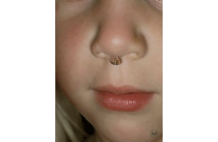 Wart under a child's nose
