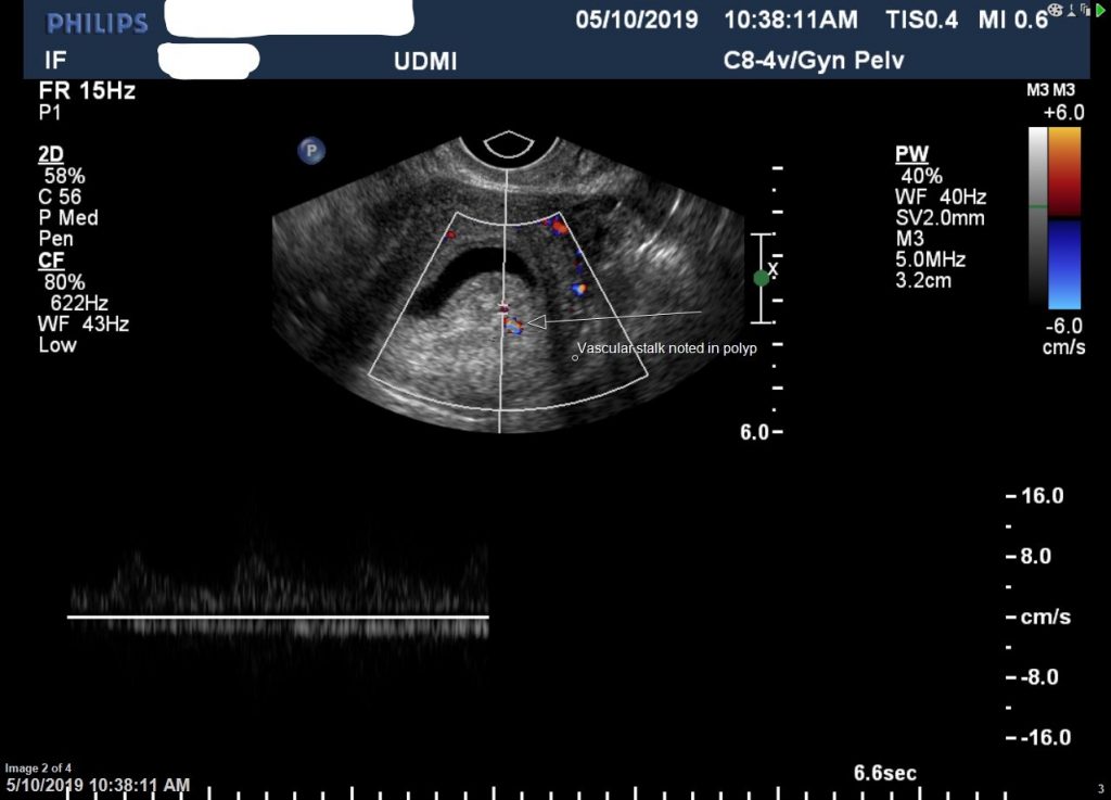 Hysterosonogram Uses, Benefits, What to Expect, FAQs Public Health