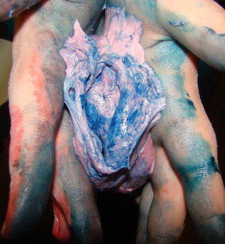  pictures of blue waffle disease as shared on facebook